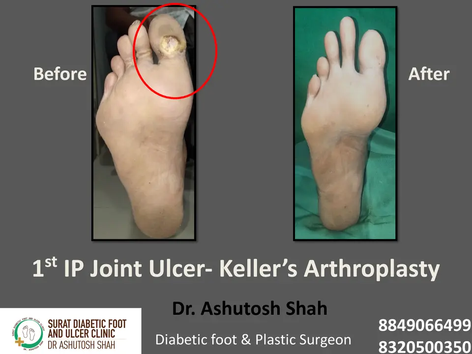 Diabetic Foot  PPT 3 checked by sir.pptx-27.webp